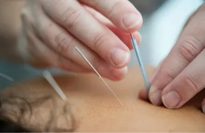 Acupuncture to improve egg freezing results